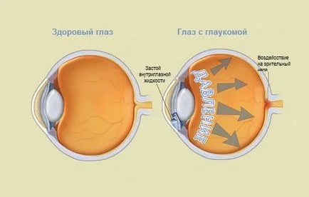 Kezelése sorvadás a látóideg, hogy javítsa a vérellátás