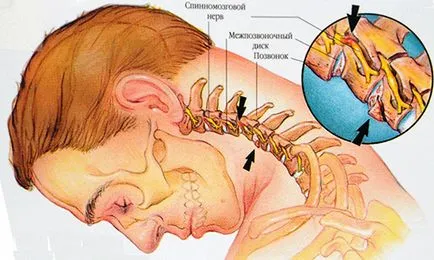 Mialgia ce, cauze, simptome, tratament, medicamente, ICD-10