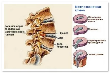 hernie intervertebral (disc intervertebral) - cauze, simptome, diagnostic, tratament, complicații