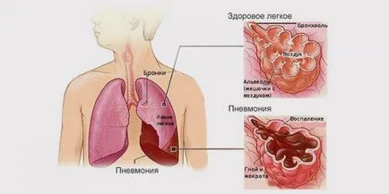 Lehet tüdőgyulladás nélkül megtörténhet láz felnőttek és gyermekek, gyulladásos tünetek a tüdőben