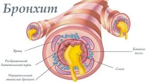 Tehetek mustár bronchitis, hogyan, hol és mikor