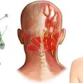 Tratamentul neuroma Morton la domiciliu