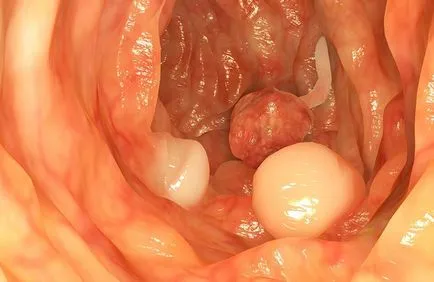 Colita ulcerativă - boli intestinale