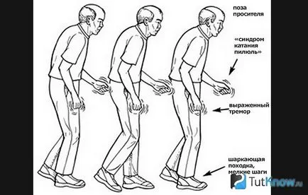 За болестта на Паркинсон