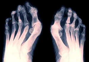 Csontritkulás láb tünetei és kezelése degeneráció a bokaízület