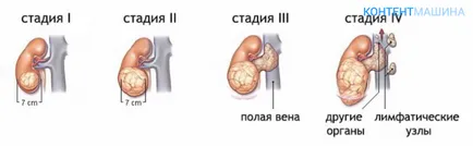 Simptomele tumorale si cancer renal si tratamentul tumorilor