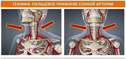 Megállítani a vérzést, a nyaki artéria
