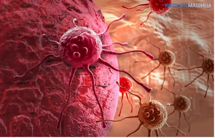 тумор и рак на бъбреците симптомите и лечението на тумори на