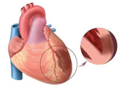 Complicațiile de infarct miocardic putem preveni consecințele