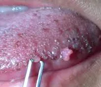 Papiloma oral - cauze, simptome, diagnostic și tratament