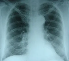 edem pulmonar - simptome, cauze, un ajutor