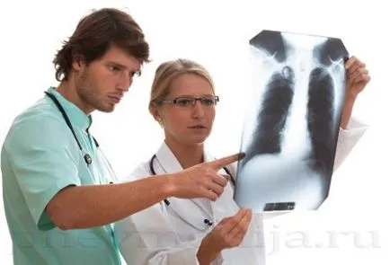 A pulmonális ödéma stroke után - kezelés a szív