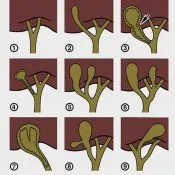 Интонацията на жлъчен мехур вродена нестабилност, фиксирани