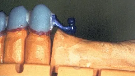 Planificarea de proiectare proteză parțială cu fixare pe inchizatoare, aladent