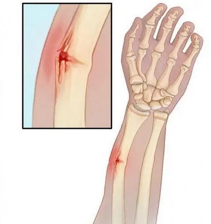 Предмишницата рехабилитация и лечение фрактура