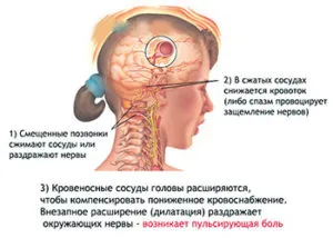 De ce există o durere de cap de col uterin - cum calma rapid durerea