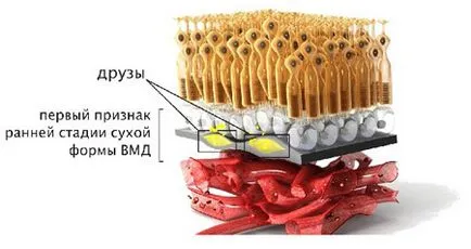 Hogyan kell menteni a látás korral járó makuladegeneráció (AMD)