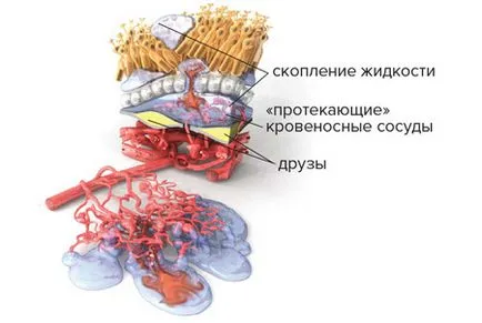 Как да запазите зрението с възрастта дегенерация на макулата, свързана (AMD)