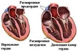 Simptomele de insuficiență cardiacă