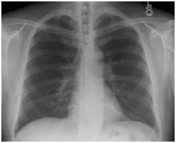 Simptomele de insuficiență cardiacă