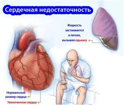 Simptomele de insuficiență cardiacă