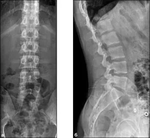 Raze X a coloanei vertebrale lombare-sacrale (preparat, foto)