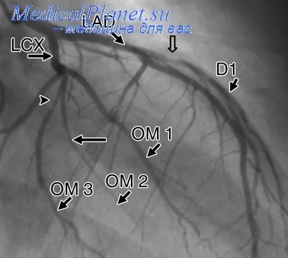 angiografia coronariană selectivă - tratamentul inimii