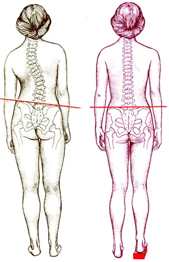 Сколиоза, причини и последици Защо едното рамо по-ниска от другата