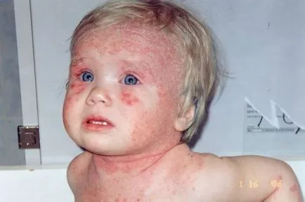 Összetettsége és hiba atópiás dermatitis diagnózisát gyermekeknél