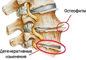 Spondiloza a coloanei vertebrale lombare, care este si modul de a trata boala