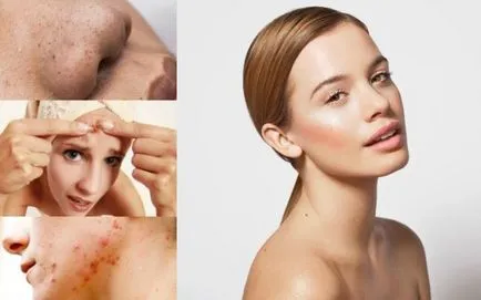 Metode de utilizare ihtiolamoniu unguente pentru acnee, acnee, comedoane pe față și nu numai - rețete