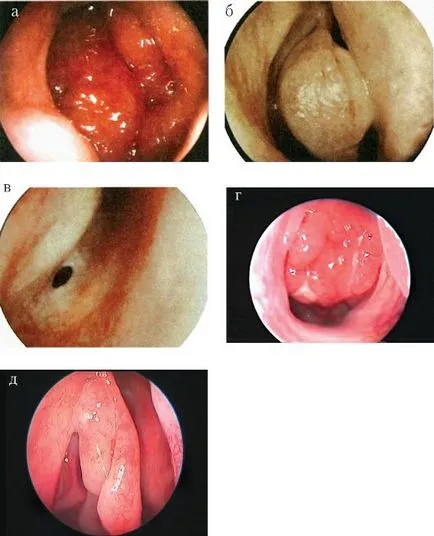 Metode moderne de chirurgie endoscopica endonazale