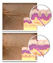 Terapia cu celule stem - crema antirid revitalizant de ridicare a pielii faciale