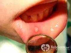 Stomatitis gyermekek és felnőttek - kezelés, a tünetek