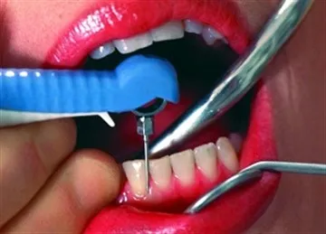 Като даде фасети за зъби - особено инсталиран на предните зъби и венци