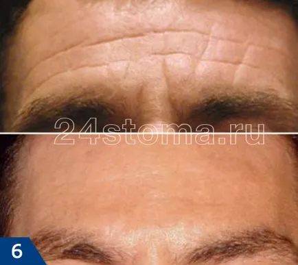 Как да премахнете бръчки по челото и между веждите - Преглед на методите