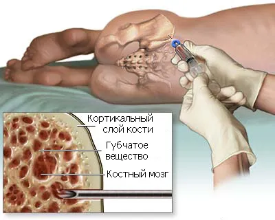 Transplantul de măduvă osoasă, immuninfo