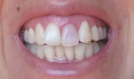 Traumás periodontitis tünetei és az akut és krónikus formái