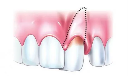 Traumás periodontitis tünetei és az akut és krónikus formái