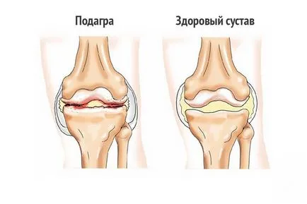 Трева ефективно лечение на подагра такси, подноси и компреси