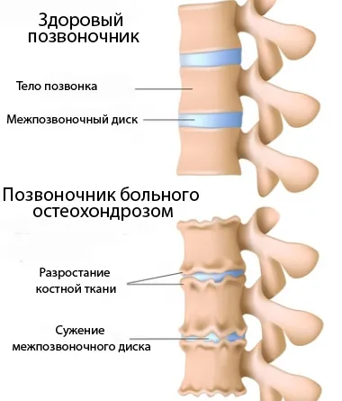 В някои случаи е необходимо гръбнака артропластика