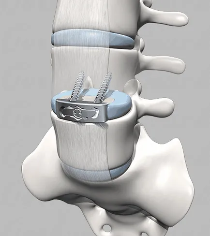 În unele cazuri, este necesară artroplastie coloanei vertebrale