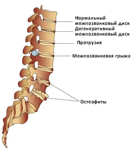 În unele cazuri, este necesară artroplastie coloanei vertebrale