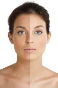 Efectul de bronzare, pigmentarea pete este posibil pentru a le elimina complet