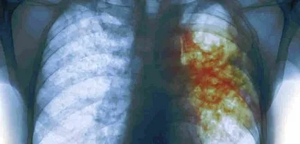 pneumonie cronică la copii, simptome vzorslyh de inflamație cronică a plămânilor