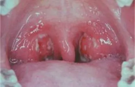 Ulceroase amigdalele - sifilis in glandele si amigdale, doua portocale