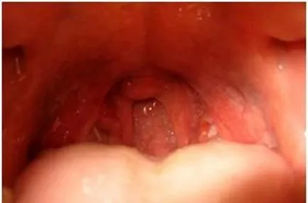 Ulceroase amigdalele - sifilis in glandele si amigdale, doua portocale