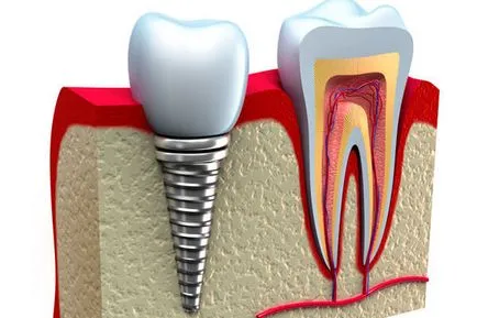 A fogászati ​​implantátum, hogy mit jelent a beszerelés költségét