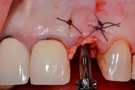 A fogászati ​​implantátum, hogy mit jelent a beszerelés költségét