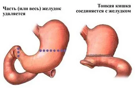 Adenocarcinomul simptomelor de stomac, tratamentul și prognosticul